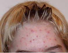 Acne on forehead 