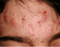 Young person with acne