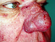 Woman having rosacea condition 02